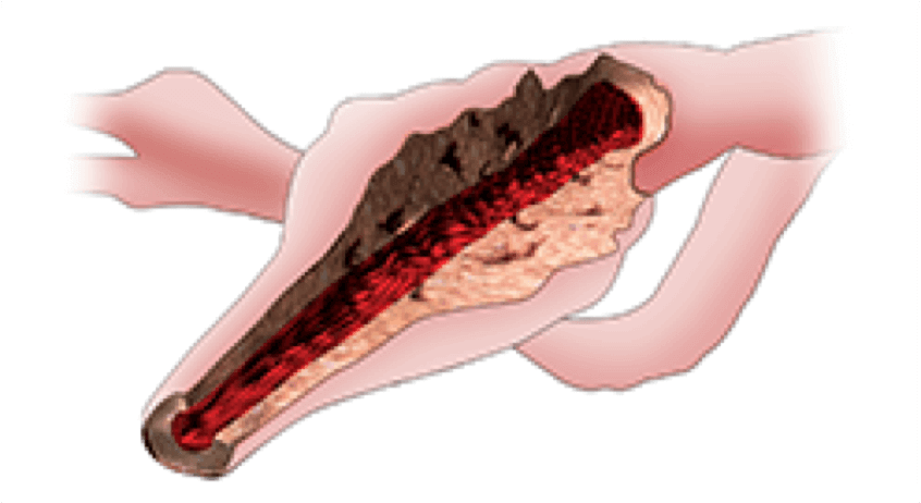 pah-thickened-artery